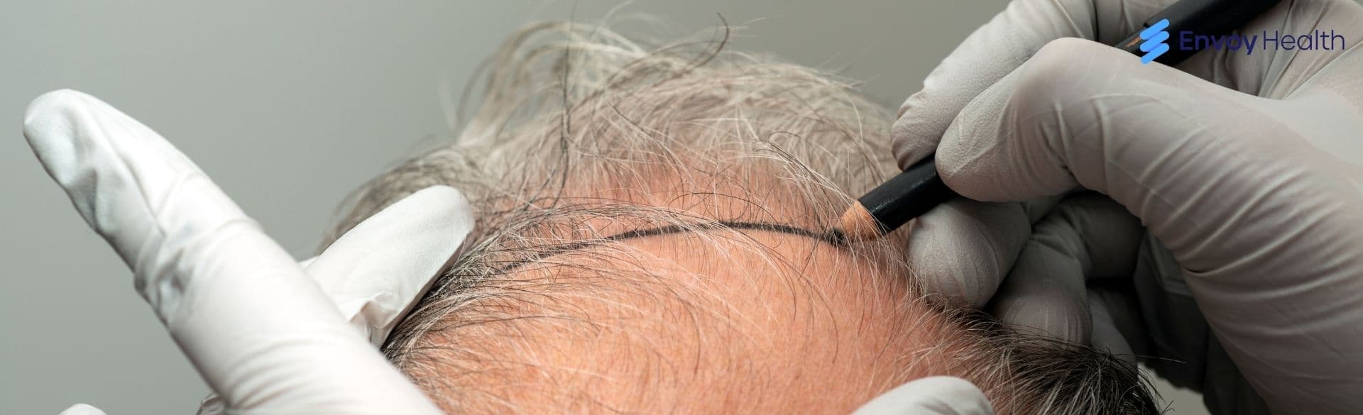 What You Should Know About Hair Transplant Turkey?