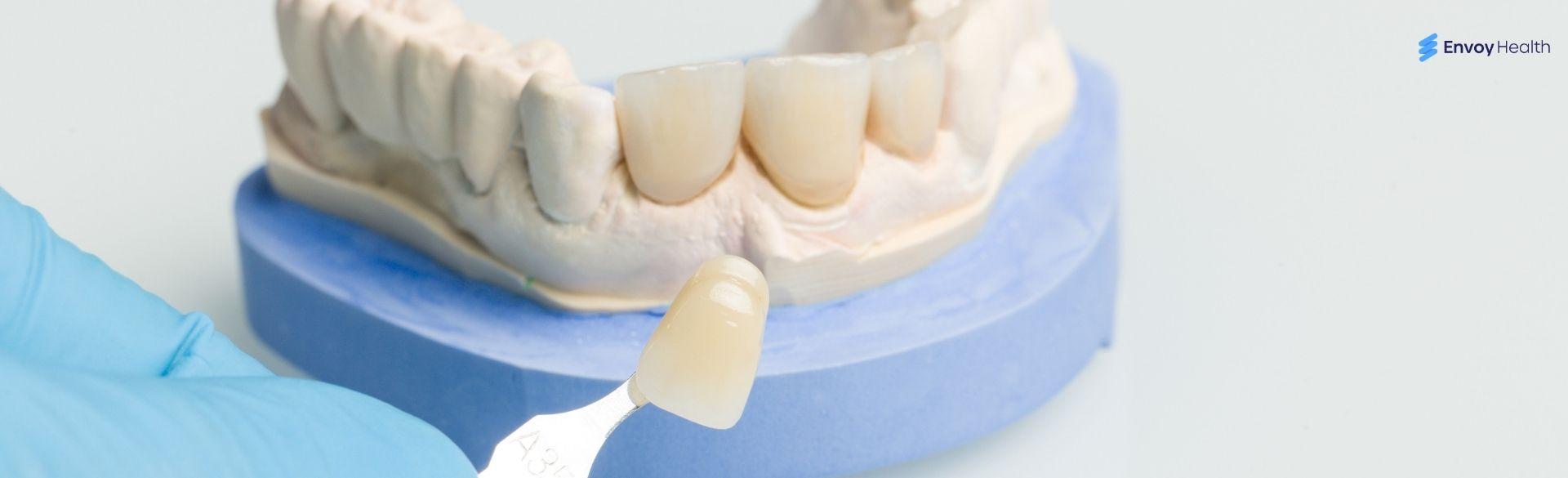 Problems With Veneers Why Do Some People Regret Them Problems With Veneers Why Do Some People Regret Them