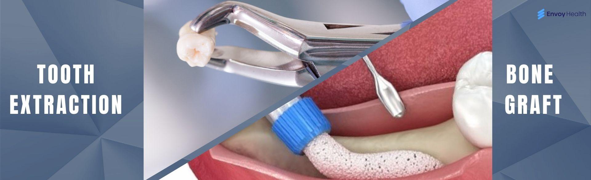 Tooth Extraction and Bone Graft Recovery: What To Expect? Tooth Extraction and Bone Graft Recovery: What To Expect?
