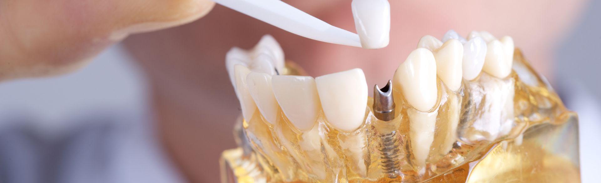 All About Dental Implants All About Dental Implants
