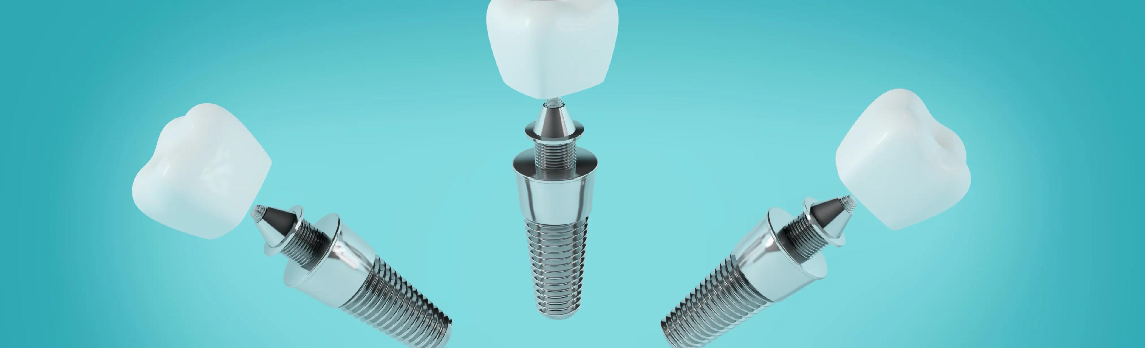 Figuring out Dental Implants Price Figuring out Dental Implants Price