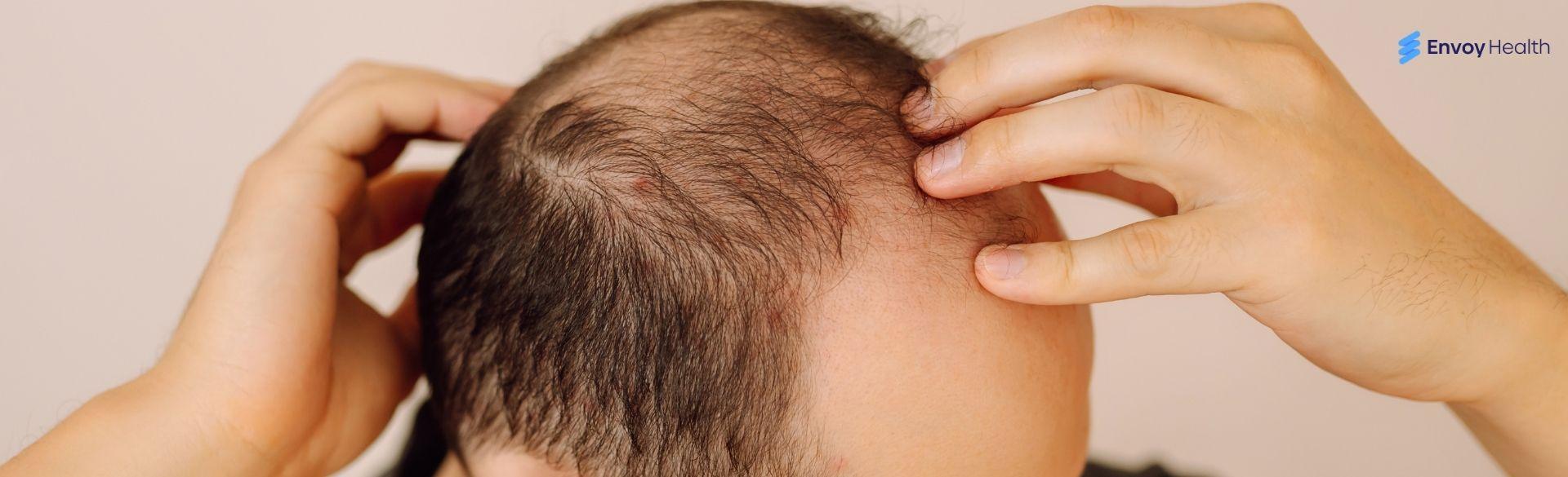 Bald Crown: Understanding Causes, Treatment, and Options Bald Crown: Understanding Causes, Treatment, and Options