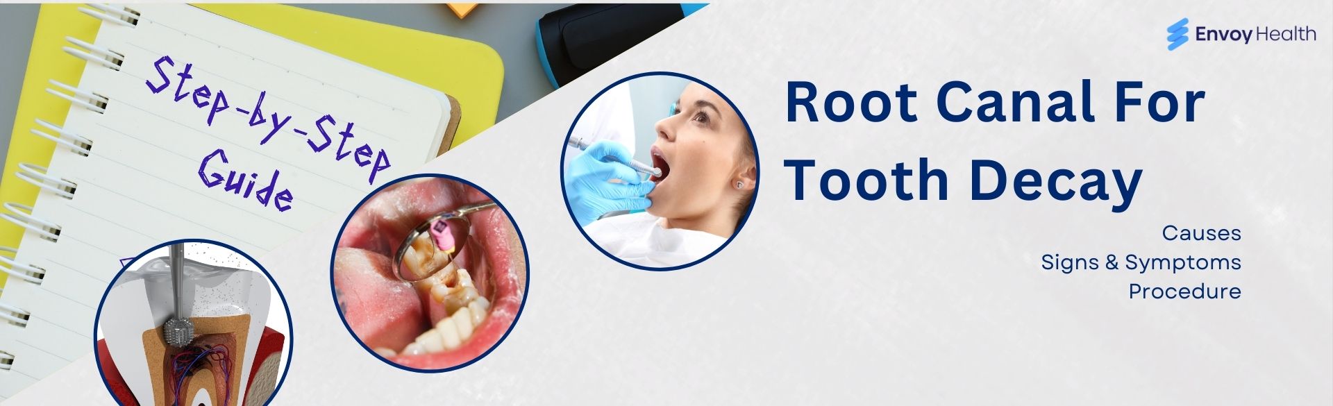 Root Canal Treatment Procedure Step-by-Step Explained