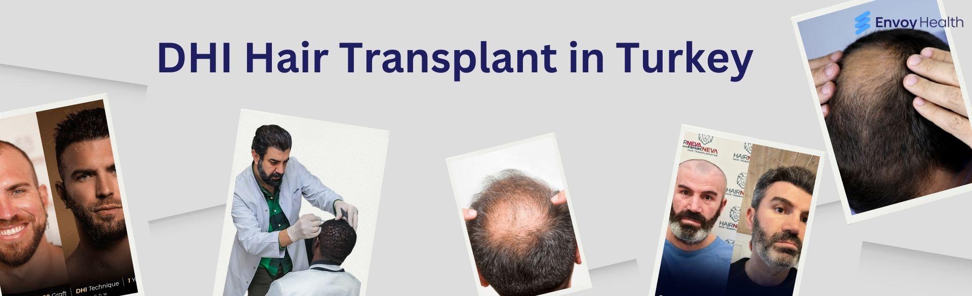 DHI Hair Transplant in Turkey: Costs and Deals at Top Clinics DHI Hair Transplant in Turkey: Costs and Deals at Top Clinics