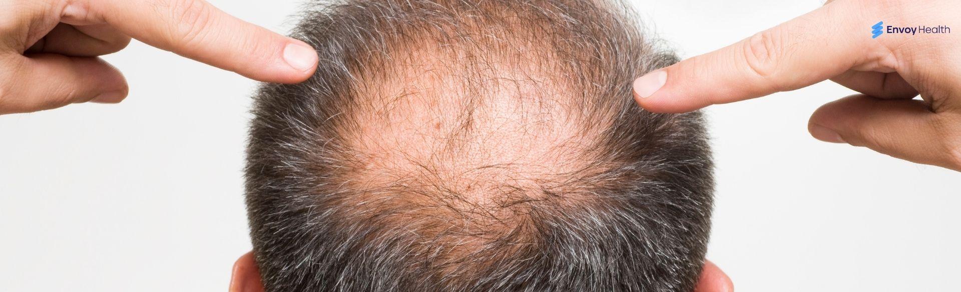 Where Is the Best Hair Transplant in the World Done Where Is the Best Hair Transplant in the World Done