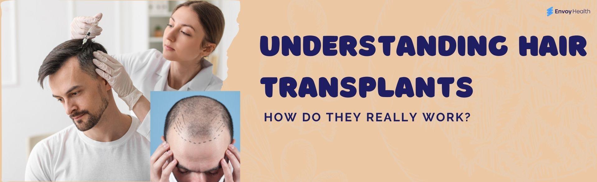 Understanding Hair Transplants: How Do They Really Work? How does hair transplant works?