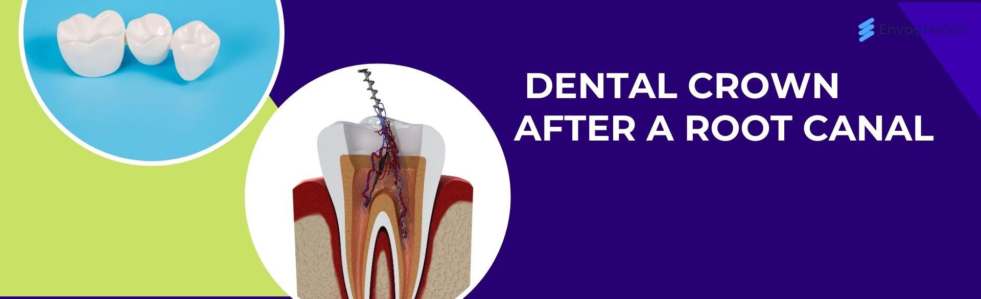 What To Know About Getting a Dental Crown After a Root Canal What To Know About Getting a Dental Crown After a Root Canal