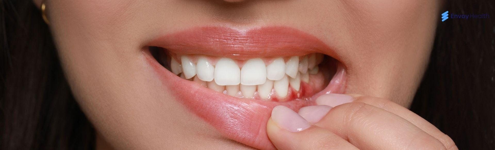 Pictures of White Spots on Gums Pictures of White Spots on Gums