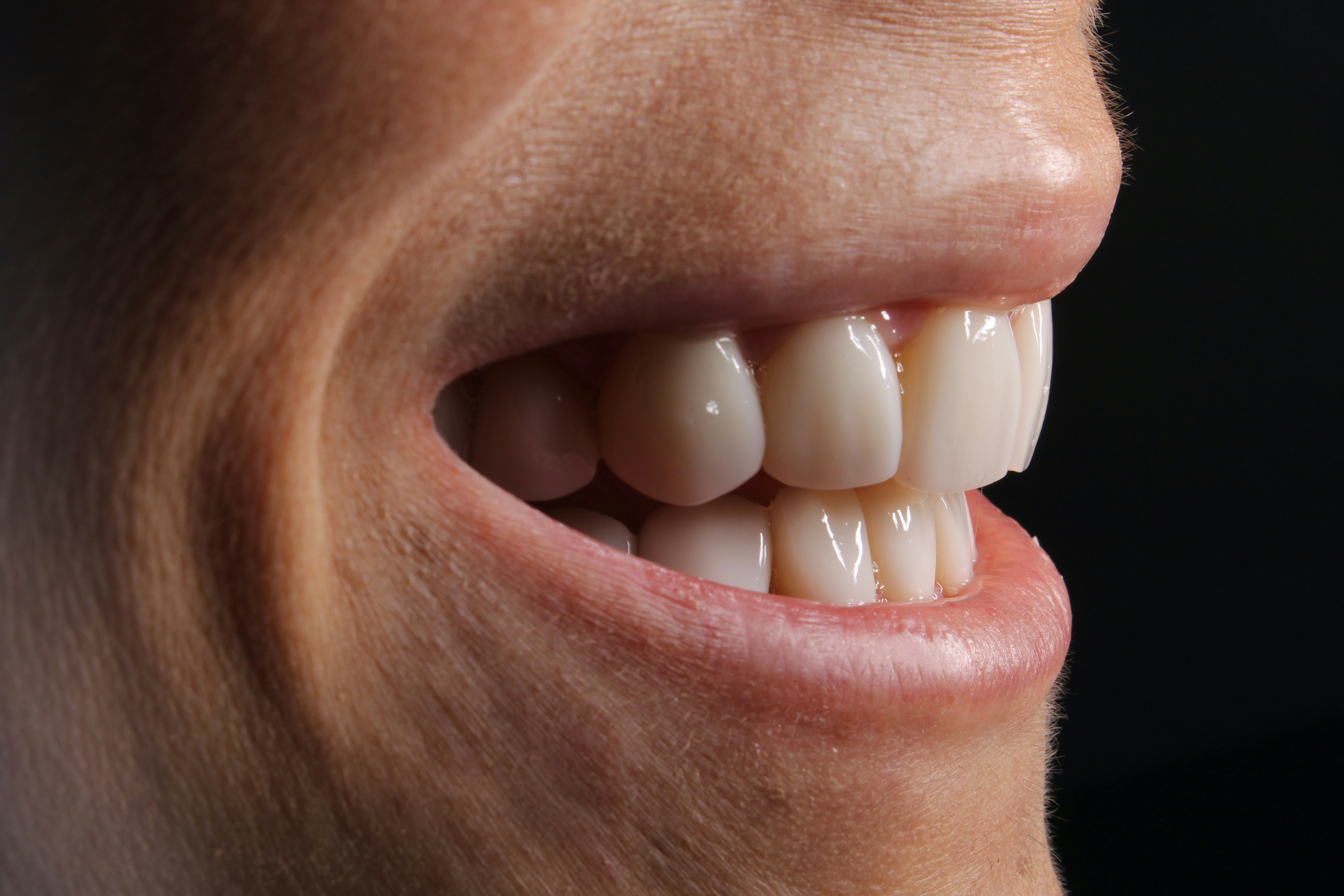 bridges on teeth bridges on teeth