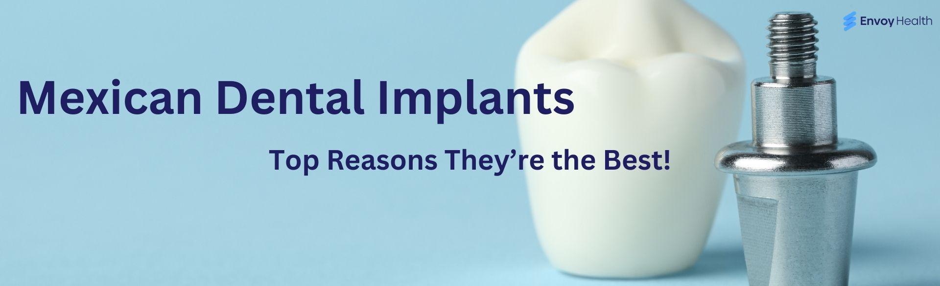Mexican Dental Implants: Top Reasons They’re the Best Mexican Dental Implants: Top Reasons They’re the Best