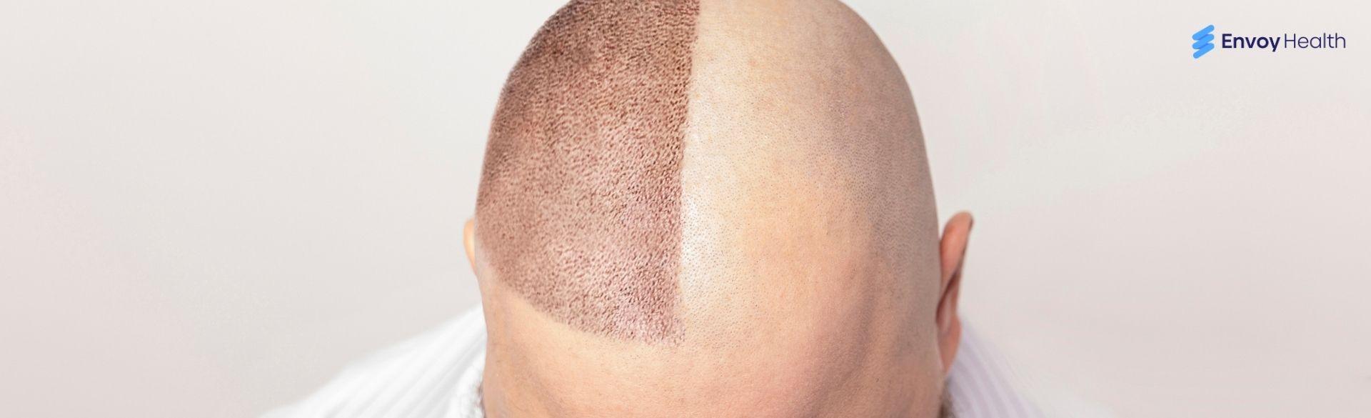 Hair Transplant Success Rate Understanding What Really Matters Hair Transplant Success Rate Understanding What Really Matters