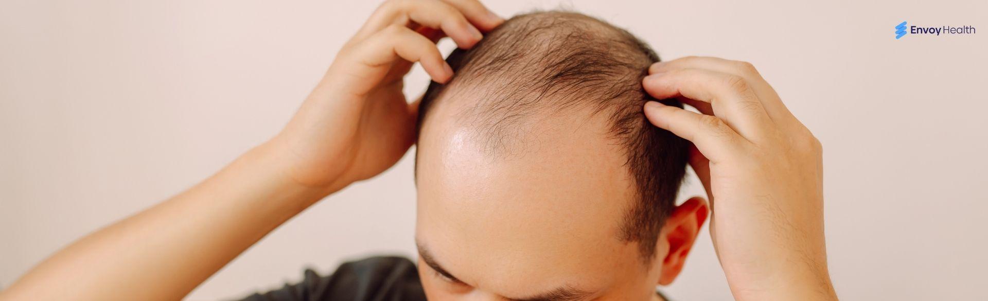 Types Of Alopecia Hair Loss: A Simple Guide To What You Might Be Dealing With Types Of Alopecia Hair Loss: A Simple Guide To What You Might Be Dealing With