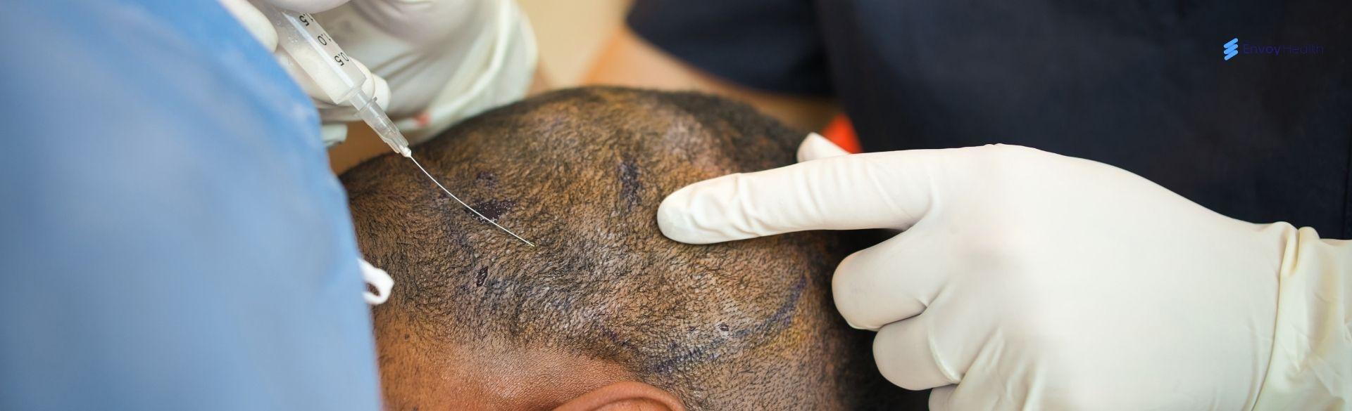 Do Hair Transplants Hurt? A Realistic Look At Pain And Recovery Do Hair Transplants Hurt? A Realistic Look At Pain And Recovery