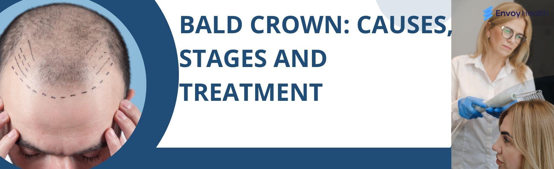 Bald Crown: Understanding Causes, Treatment, and Options Bald Crown: Understanding Causes, Treatment, and Options